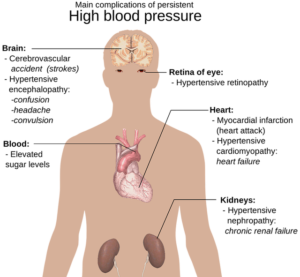 hypertension